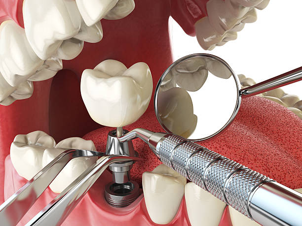 Best Emergency Treatment for Dental Infections or Abscesses in Lake Wildwood, CA
